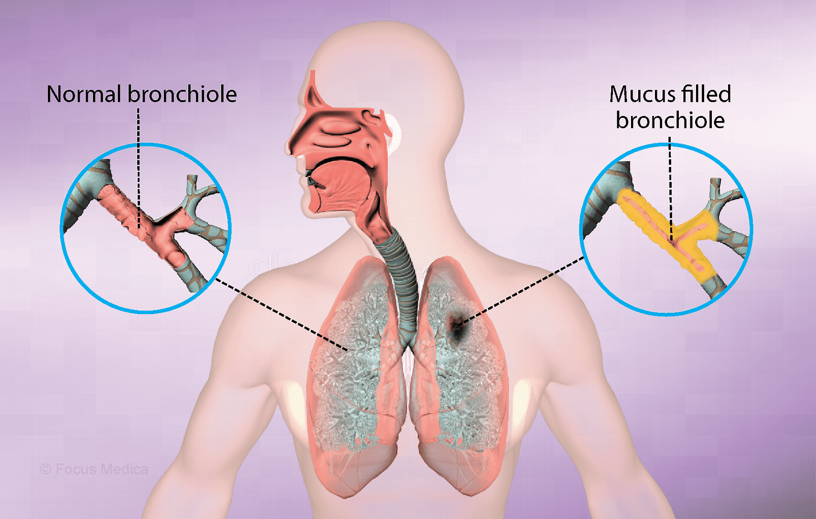 Bronchitis in Hindi