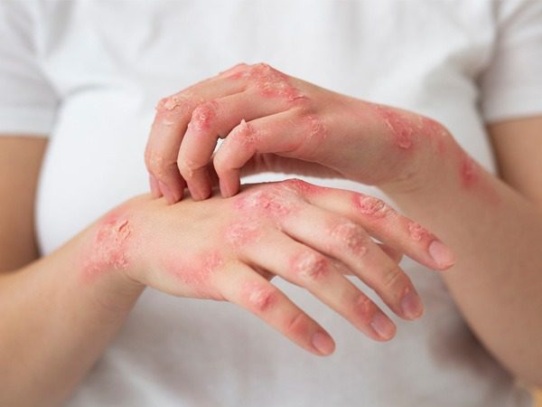Eczema in Hindi : एक्जिमा (Eczema) के कारण, लक्षण, इलाज, दवा, परहेज
