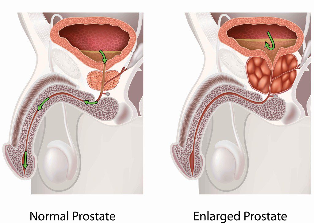 Enlarged Prostate in Hindi Symptoms, Causes, Treatment, Medicine