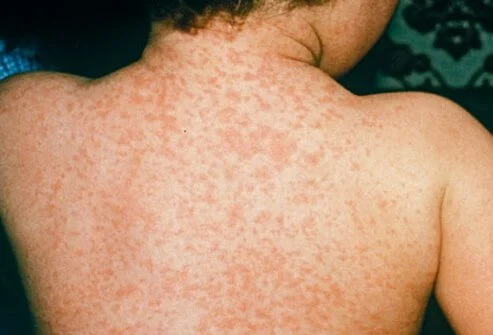 Measles in Hindi: खसरा (Measles) के कारण, लक्षण, इलाज, दवा, परहेज